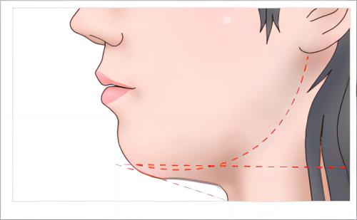 下巴脂肪过多卡通示例图