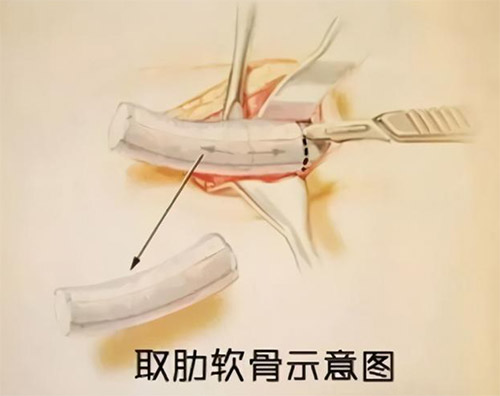 肋骨鼻手术过程图