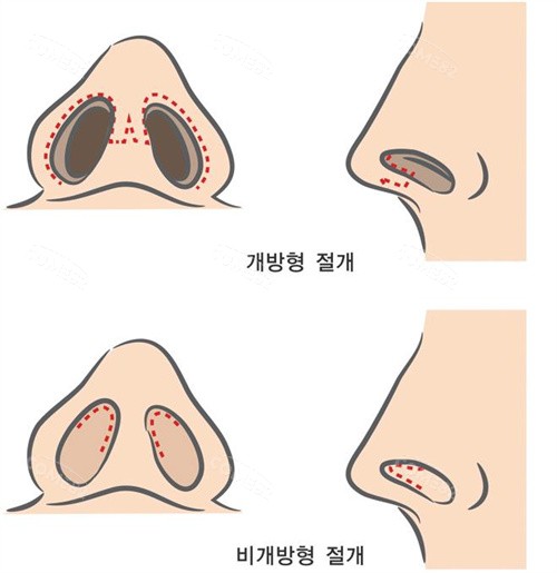 鼻翼矫正手术素材图