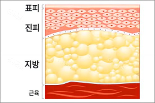 抽脂脂肪层示例图