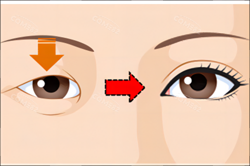 单眼皮变双眼皮对比示例图
