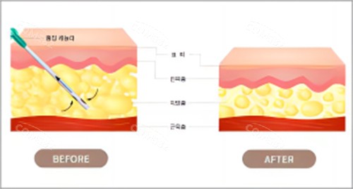 抽脂脂肪前后对比图