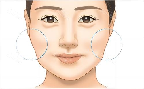 颧骨机脸颊下垂示例图