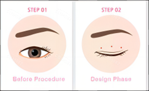 卡通三点式双眼皮术前步骤示意图