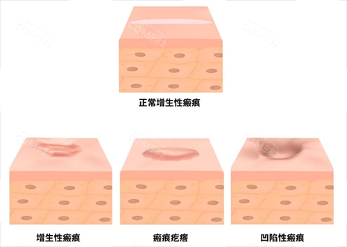 疤痕类型示意图